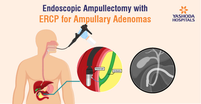 Endoscopic Ultrasound Guided Hepatico Gastrostomy Yashoda Hospitals