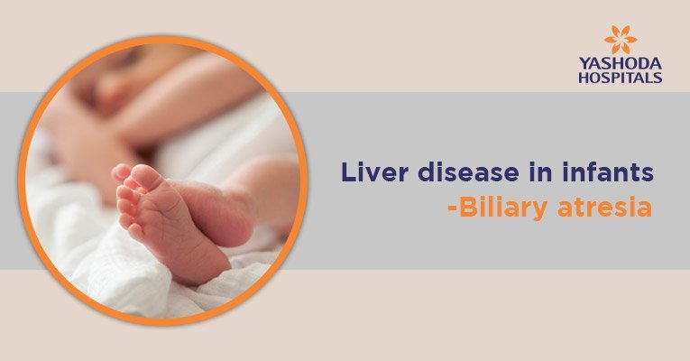 Biliary Atresia Symptoms Causes Risk Factors Diagnosis And Treatment