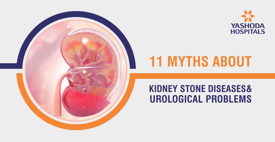 11 Myths about stone diseases and urological problems