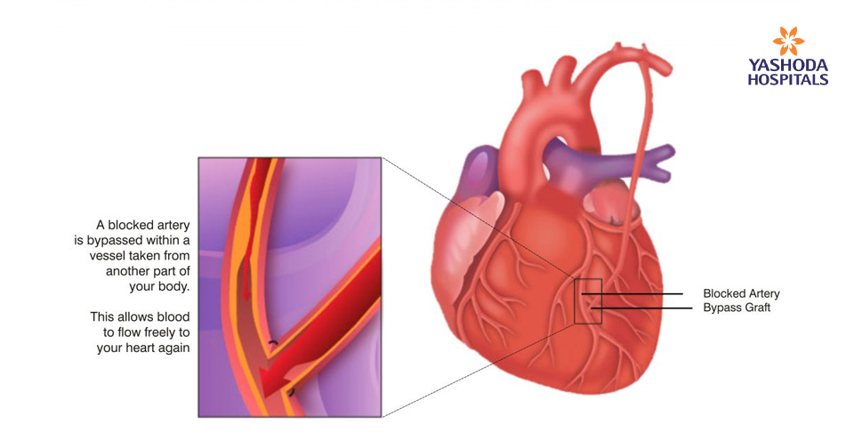 Benefits of Minimally Invasive Cardiac Bypass Surgery (MICS)