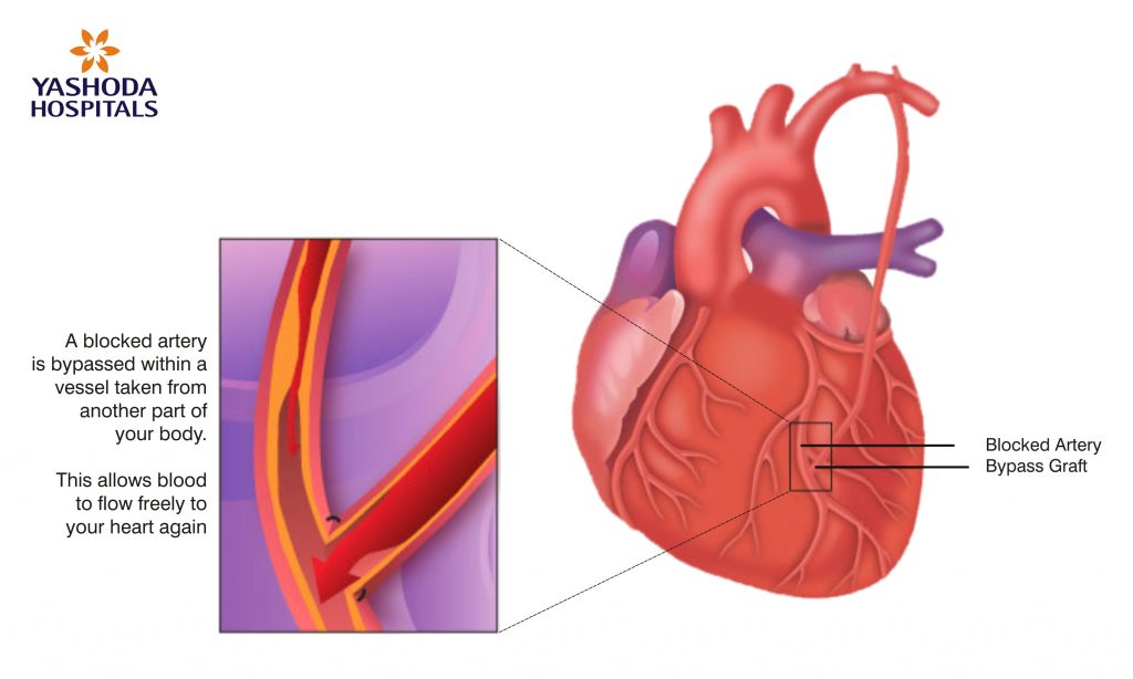 Benefits Of Minimally Invasive Cardiac Bypass Surgery (MICS)