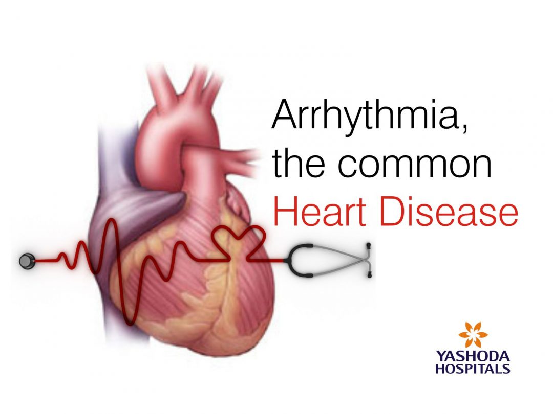 Arrhythmia, The Common Heart Disease