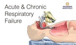 Acute and Chronic Respiratory Failure treatment and diagnostic