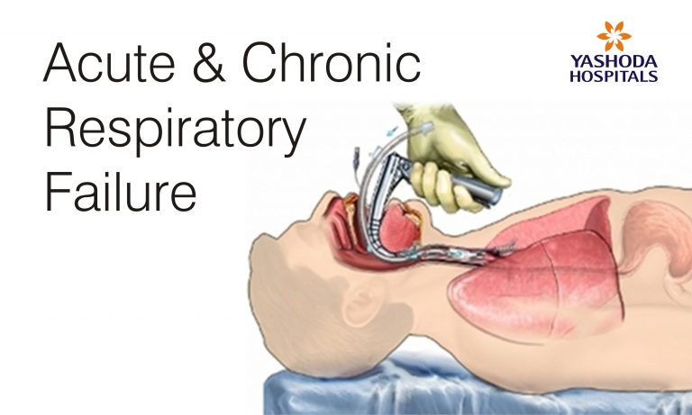 acute-and-chronic-respiratory-failure-treatment-and-diagnostic