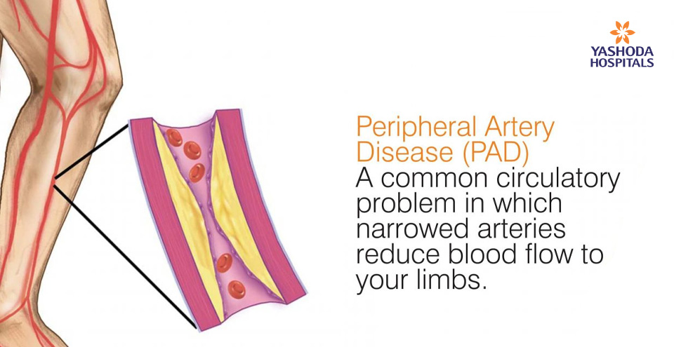 Peripheral Artery Disease (PAD)  A common circulatory problem in which narrowed arteries reduce blood flow to your limbs