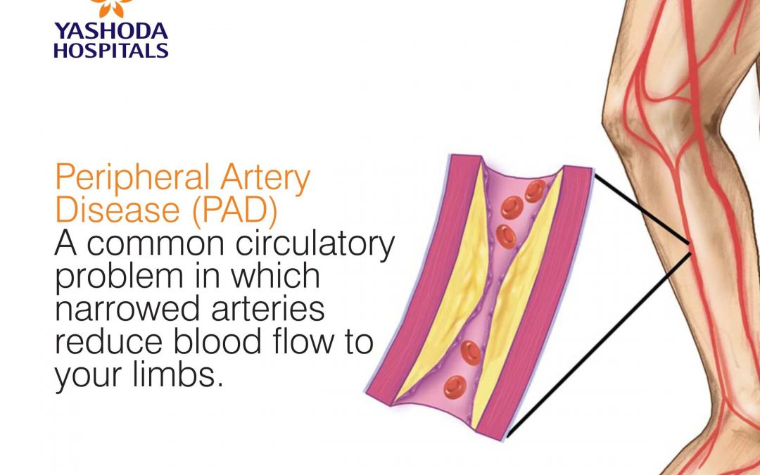 Peripheral Artery Disease (PAD)  A common circulatory problem in which narrowed arteries reduce blood flow to your limbs