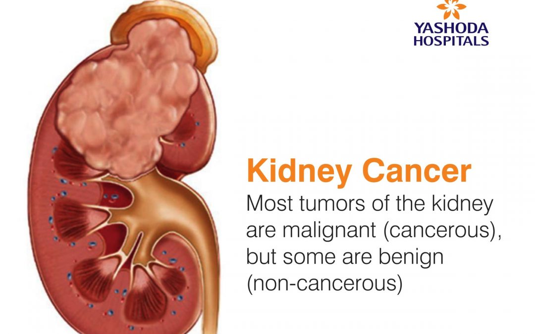 Are all tumors of kidney cancerous?