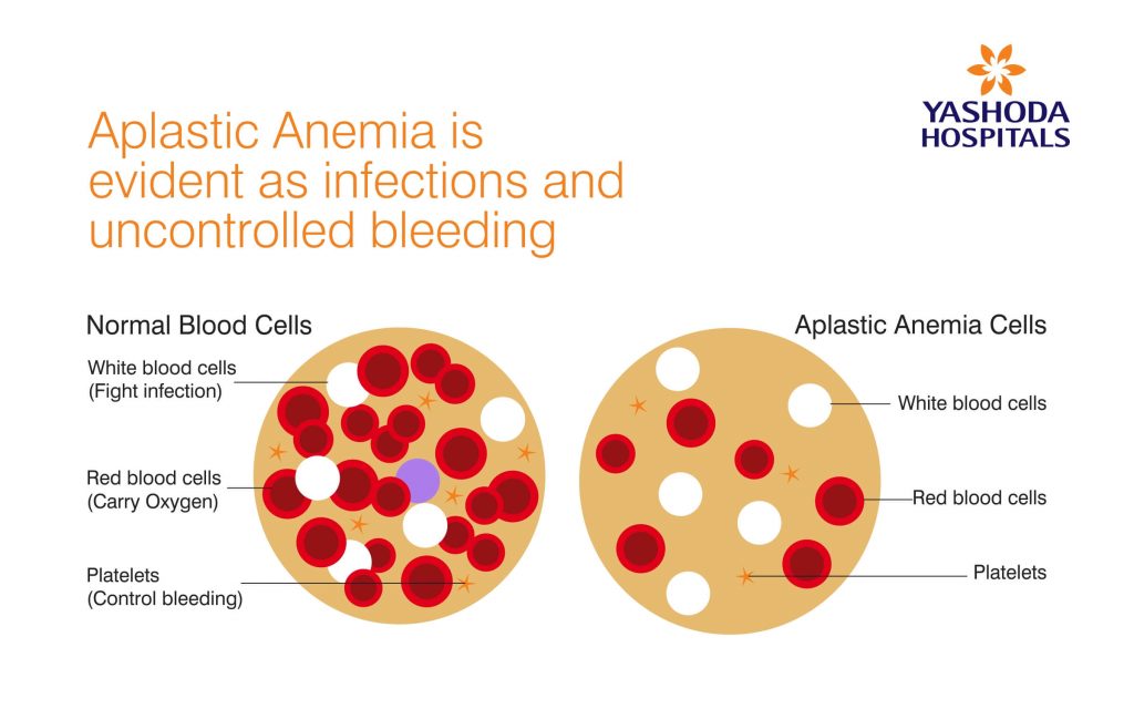 Aplastic Anemia is evident as infections and uncontrolled bleeding