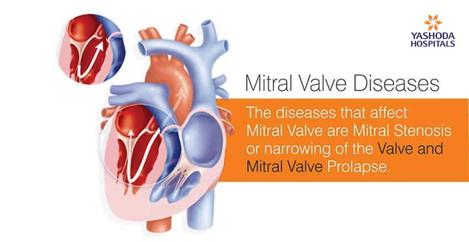 Transcatheter Mitral Valve Replacement (TMVR) for mitral valve diseases