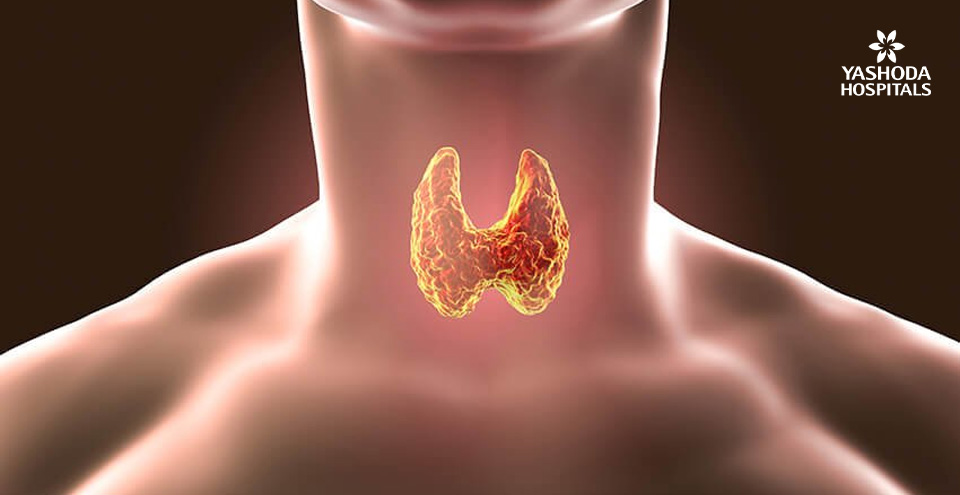 Hypothyroidism is a common disorder of the endocrine system