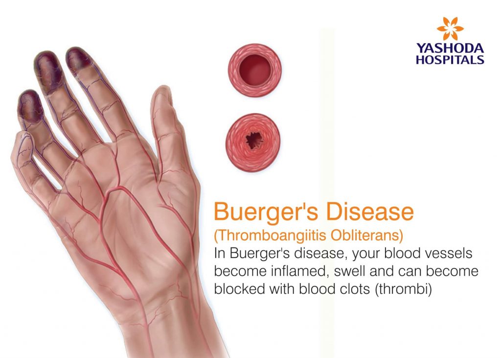 What is Buerger's disease ? Causes, Symptoms, Risk & Complications