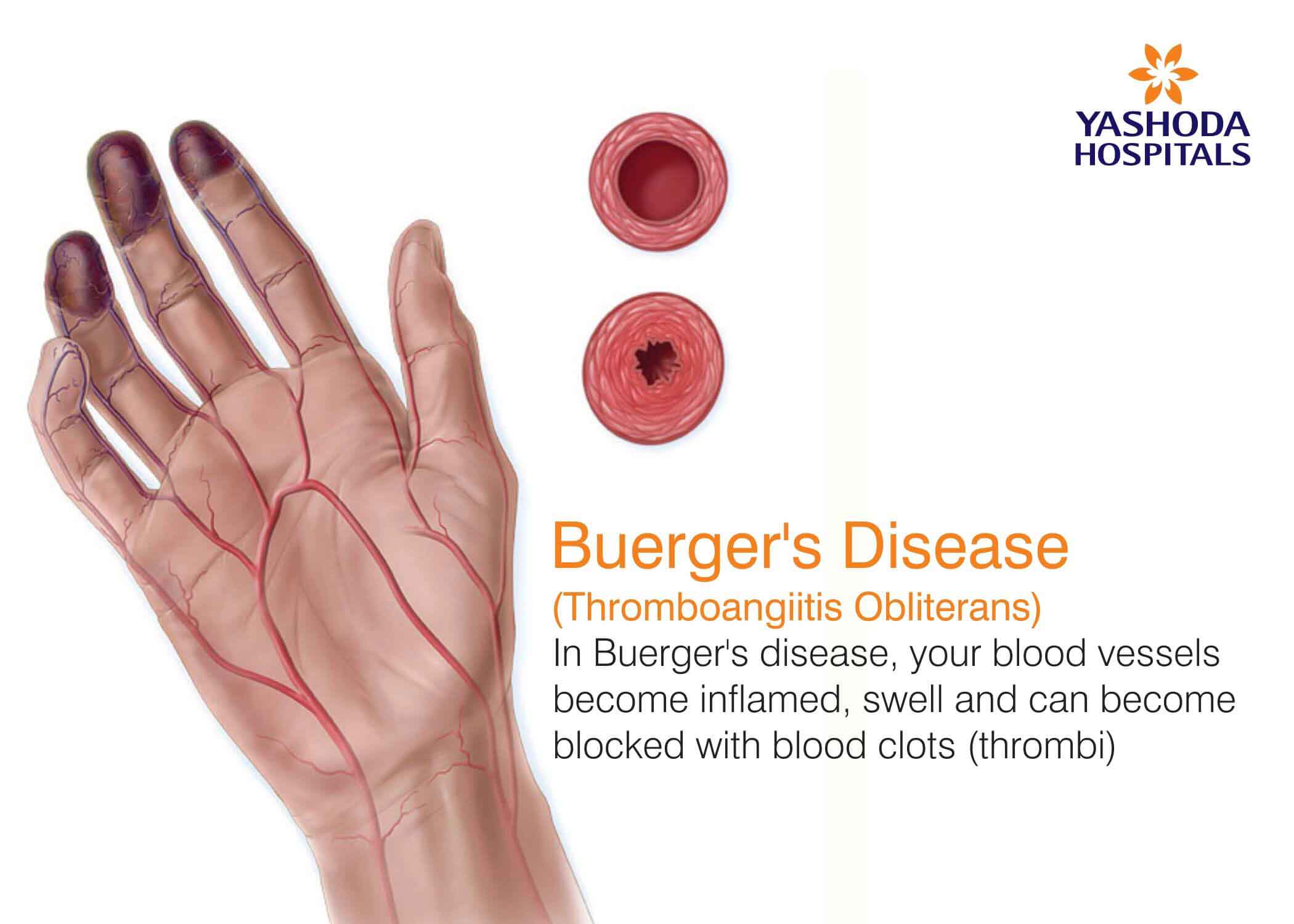 Buerger's Disease Photos at Pearl Pratt blog