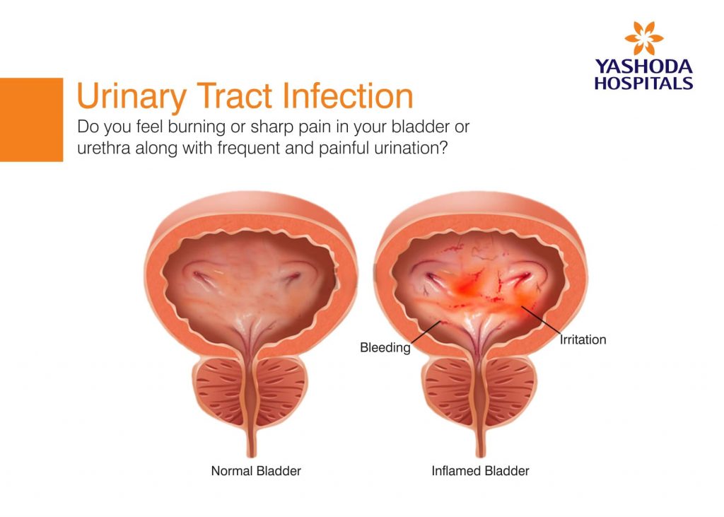 urinary-tract-infection-women