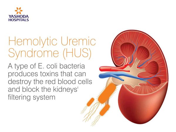 Hemolytic Uremic Syndrome (HUS) - Yashoda Hospitals