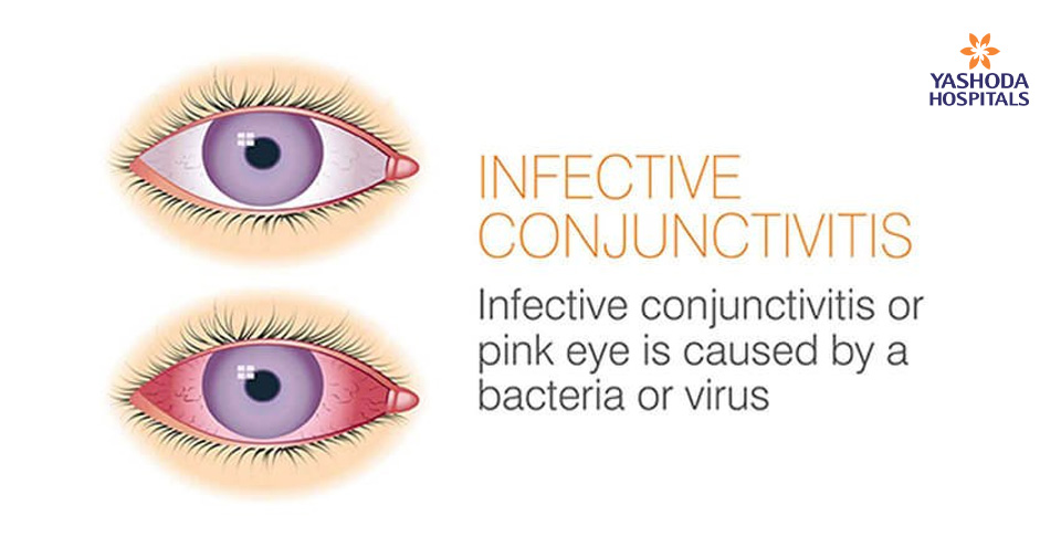 Infective Conjunctivitis