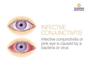 Infective Conjunctivitis