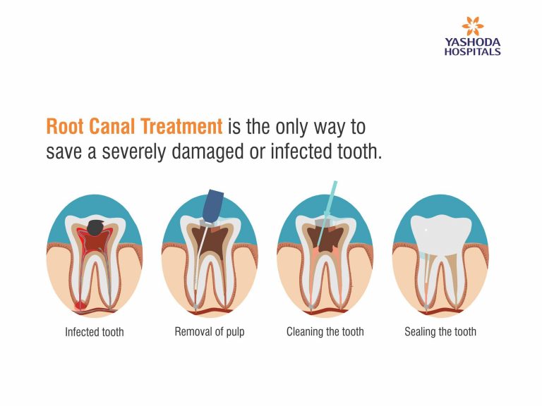 What is a Root Canal and do you need it? Root Canal Treatment in