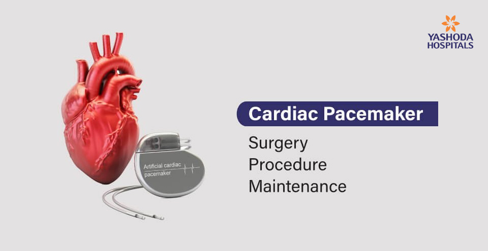 All About the Cardiac Pacemaker