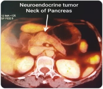 Central Pancreatectomy