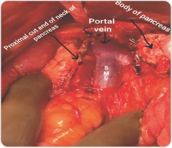 Central Pancreatectomy