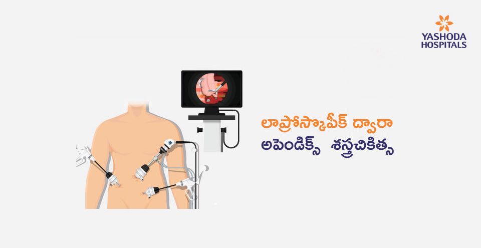 Laparoscopic Appendix Removal Surgery