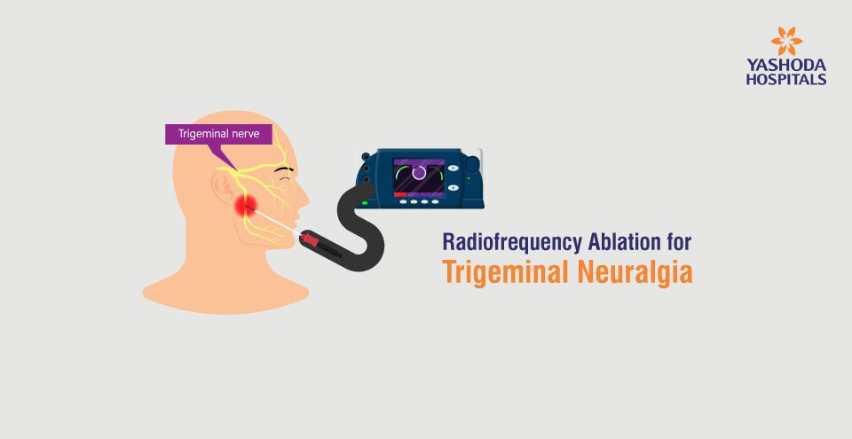 Radiofrequency Ablation for Trigeminal Neuralgia