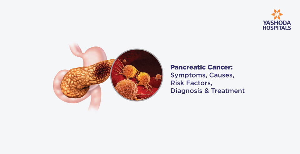 Pancreatic Cancer: Symptoms, Causes, Risk Factors, Diagnosis, Treatment