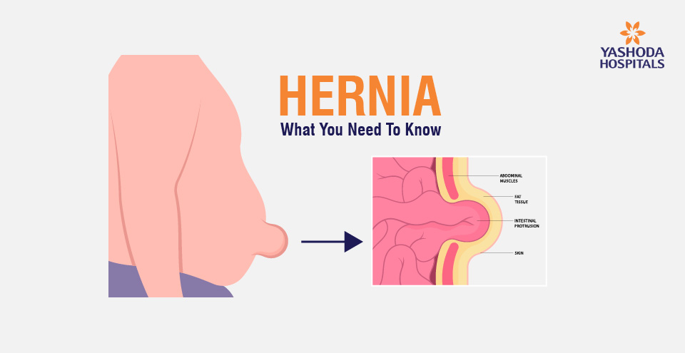 Hernia: What You Need To Know