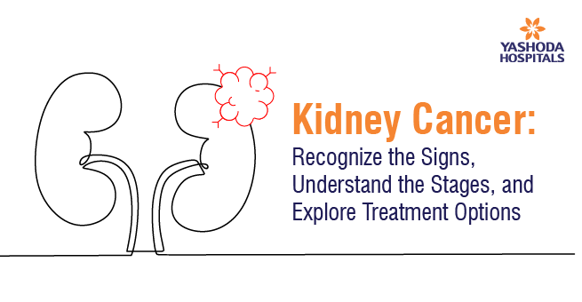 Kidney Cancer: Recognize the Signs, Understand the Stages, and Explore Treatment Options