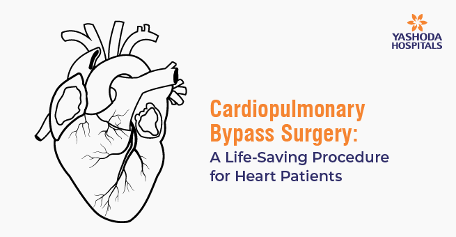 Cardiopulmonary Bypass Surgery: A Life-Saving Procedure for Heart Patients