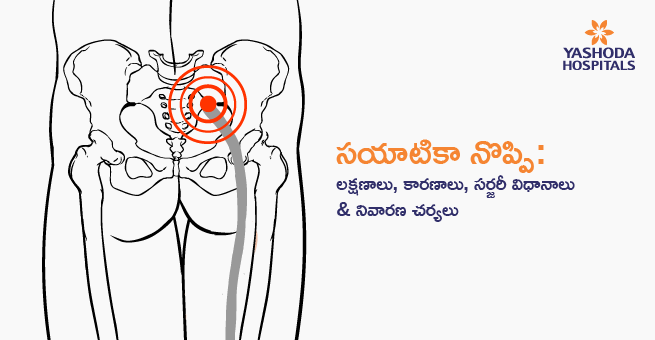 సయాటికా నొప్పి: లక్షణాలు, కారణాలు, సర్జరీ విధానాలు & నివారణ చర్యలు