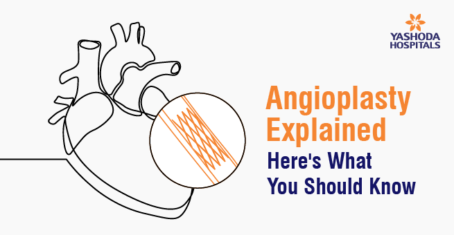 Angioplasty Explained: Here’s What You Should Know