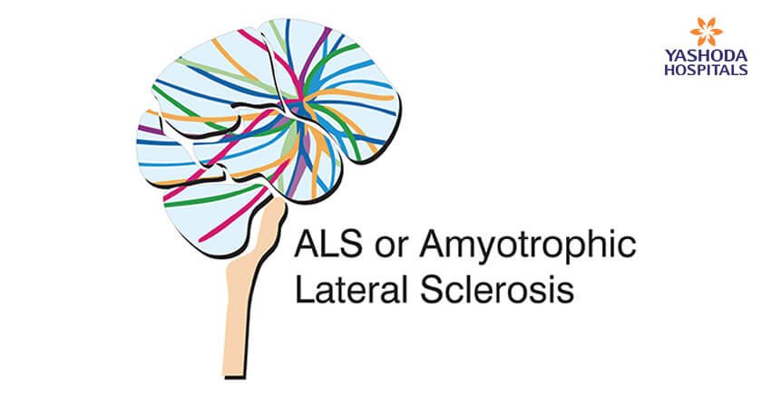 Als Or Amyotrophic Lateral Sclerosis