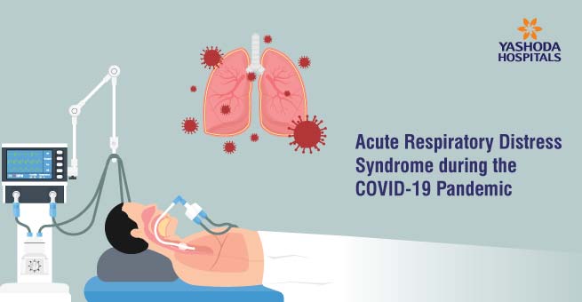 Acute Respiratory Distress Syndrome during the  COVID-19 Pandemic