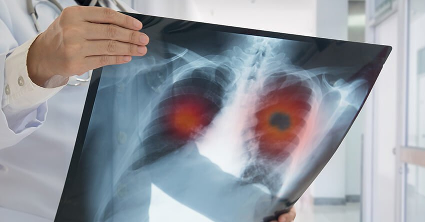 Acute and Chronic Respiratory Failure