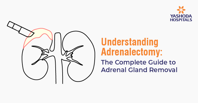 Understanding Adrenalectomy: The Complete Guide to Adrenal Gland Removal