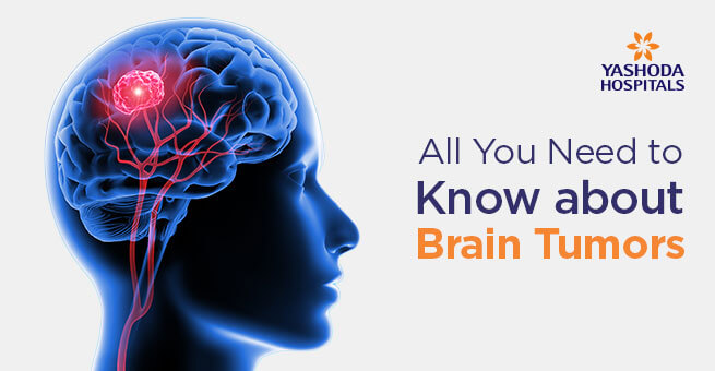 All You Need to Know about Brain Tumors