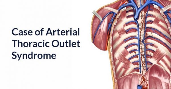 thoracic outlet syndrome symptoms night