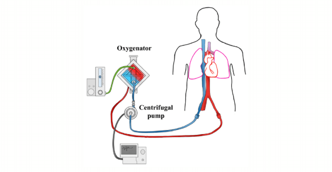 Advantages of Awake ECMO