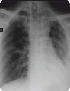 Balloon Bronchoplasty of Tubercular Stenosis - Yashoda Hospitals