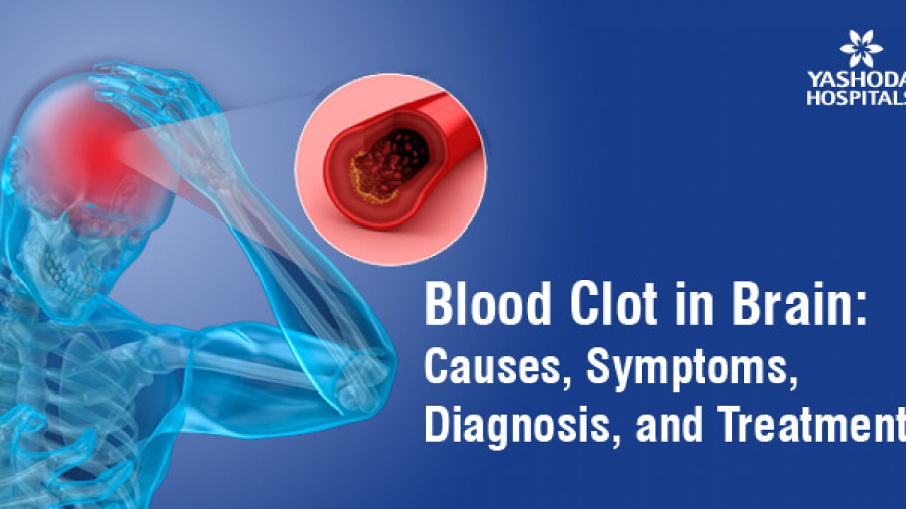 Blood Clot: Symptoms, Treatment, Prevention, and More