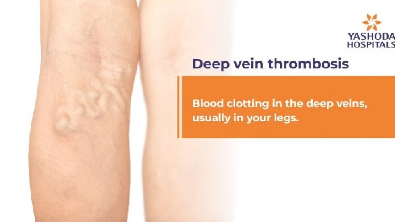 Physiotherapy for Deep Vein Thrombosis (DVT)