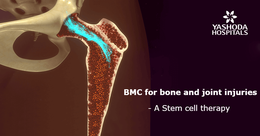 Bone Marrow Concentrate (BMC), a regenerative therapy for bone and joint injuries