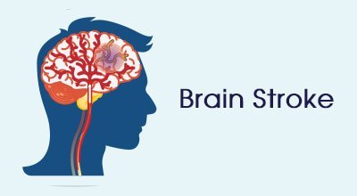 Brain Stroke - Yashoda Hospitals