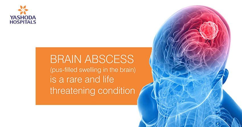 Brain Abscess