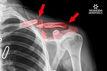 signs of a broken collarbone