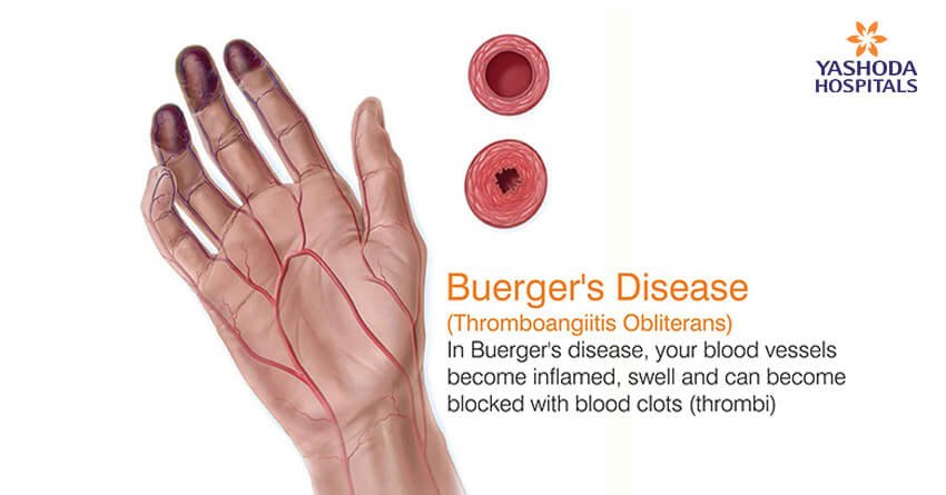 What is Buerger's disease ? Causes, Symptoms, Risk & Complications