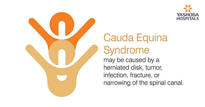 Cauda equina syndrome may be caused by a herniated disk, tumor, infection, fracture, or narrowing of the spinal canal