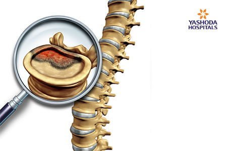 Chordoma: What Is Chordoma, Its Causes?