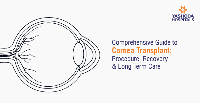 Comprehensive Guide to Cornea Transplant: Procedure, Recovery, and Long-Term Care